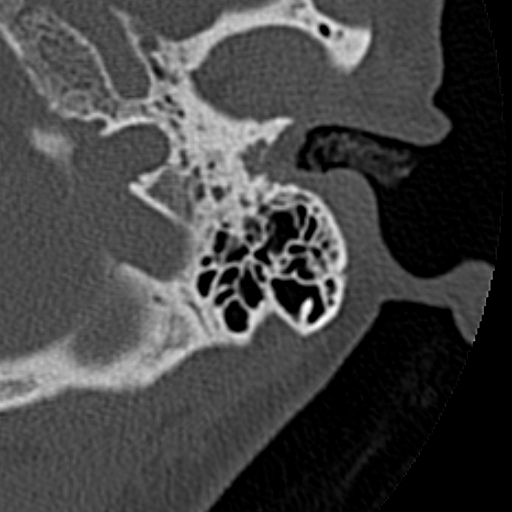 File:Cholesteatoma of the external ear (Radiopaedia 16540-16225 Axial bone window 28).jpg
