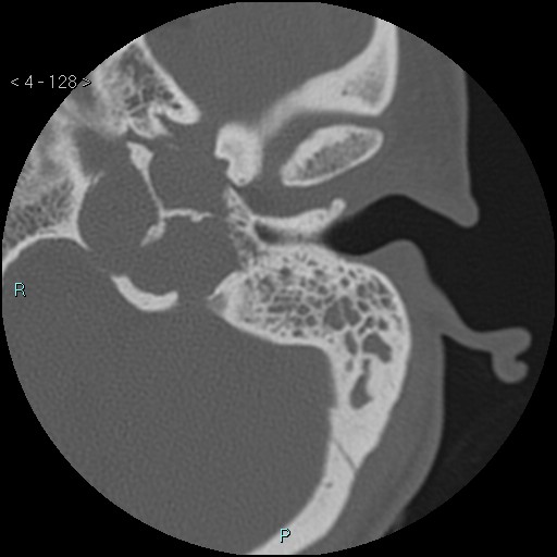 Cholesterol granuloma of the petrous apex (Radiopaedia 64358-73141 Axial bone window 62).jpg