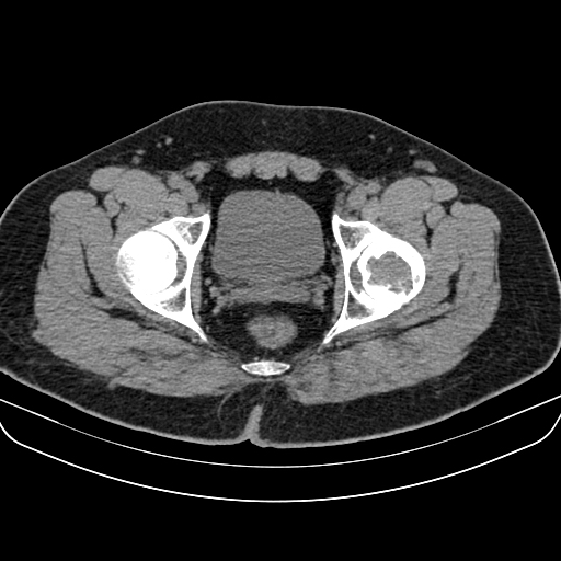 File:Chondroblastoma (Radiopaedia 12264-12563 Axial non-contrast 1).jpg