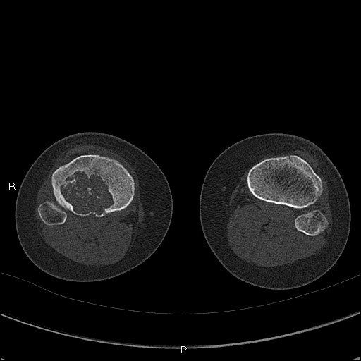 Chondroblastoma (Radiopaedia 62721-71030 Axial bone window 68).jpg