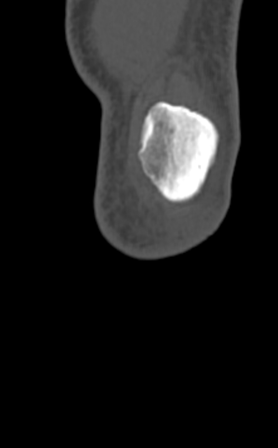 Chondrocalcinosis (Radiopaedia 82862-97173 Coronal bone window 5).jpg
