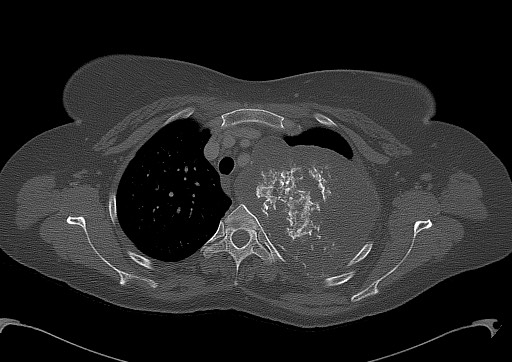 Chondrosarcoma - chest wall (Radiopaedia 65192-74199 Axial bone window 34).jpg