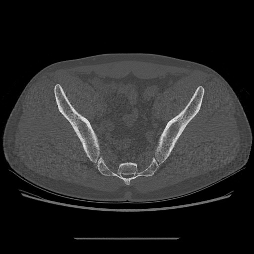 File:Chondrosarcoma of iliac wing (Radiopaedia 63861-72599 Axial bone window 75).jpg
