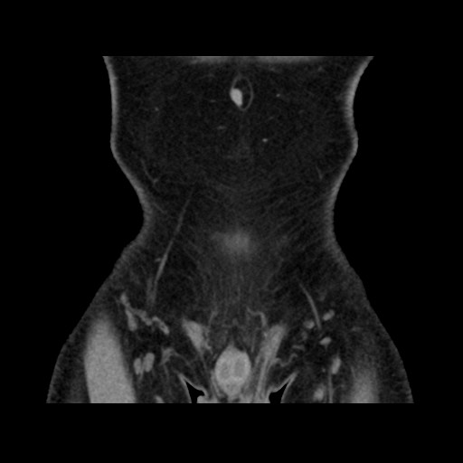 Chondrosarcoma of iliac wing (Radiopaedia 63861-72599 Coronal non-contrast 20).jpg