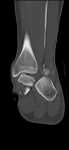 Chopart fracture (Radiopaedia 35347-36851 Coronal bone window 26).jpg