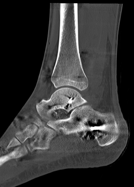 Chopart fracture (Radiopaedia 35347-36861 Sagittal bone window 45).jpg