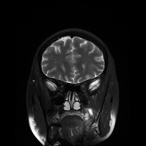 File:Chordoid glioma of third ventricle (Radiopaedia 91612-109340 Coronal T2 7).jpg