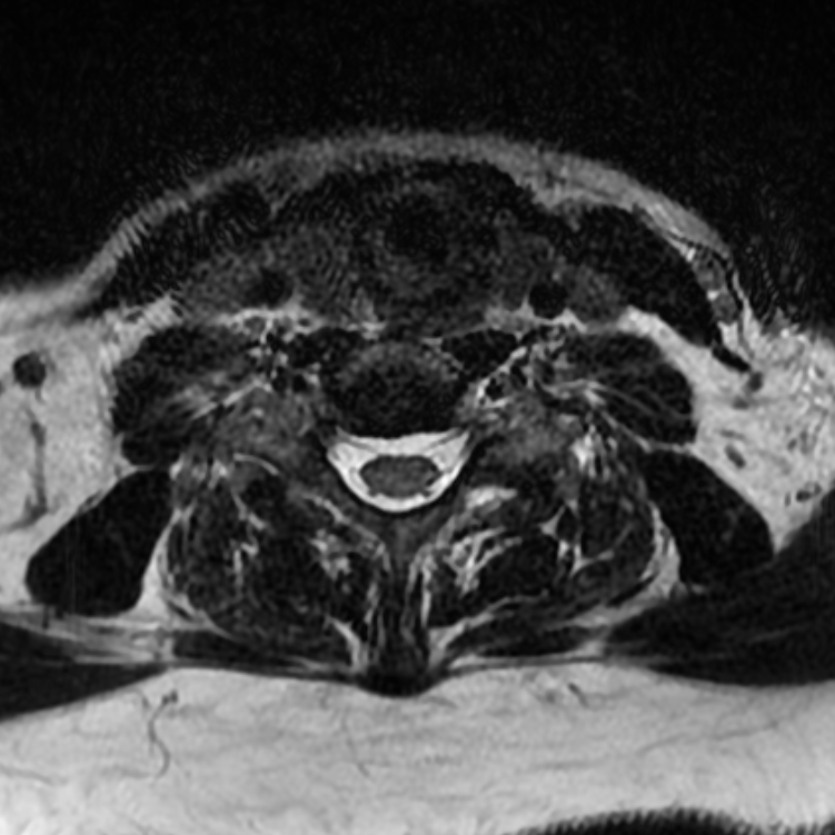 Chordoma - cervical spine (Radiopaedia 70084-80111 Axial T2 68).png