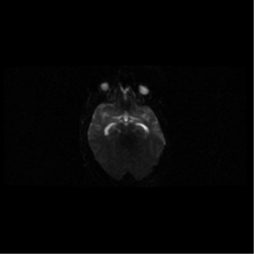 Choroid plexus papilloma (Radiopaedia 34951-36441 Axial DWI 39).png