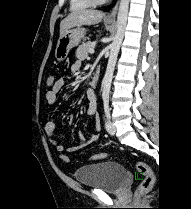Chromophobe renal cell carcinoma (Radiopaedia 84286-99573 I 84).jpg