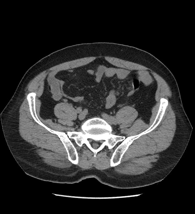 Chromophobe renal cell carcinoma (Radiopaedia 86879-103083 Axial non-contrast 90).jpg