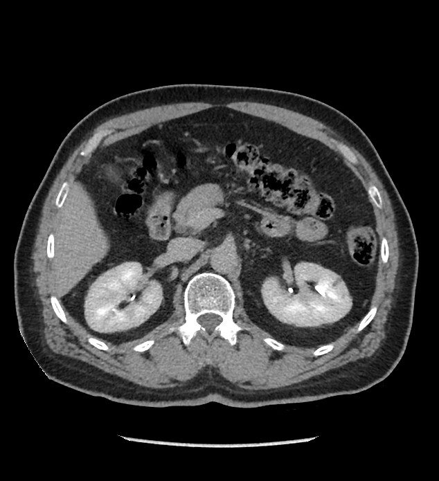 Chromophobe renal cell carcinoma (Radiopaedia 86879-103083 D 49).jpg