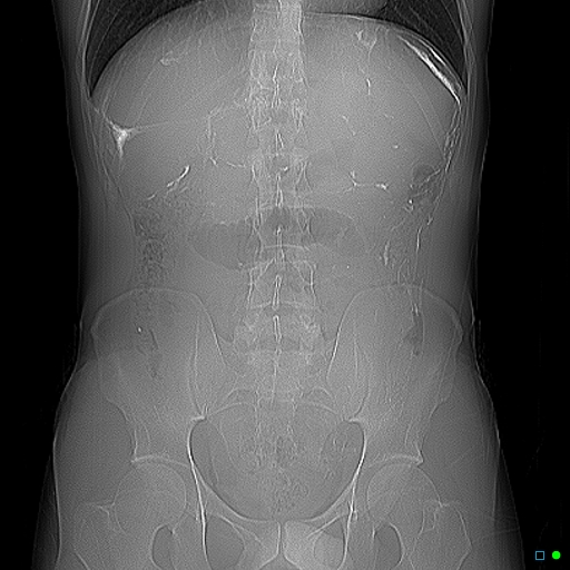 File:Chronic barium peritonitis and small bowel obstruction (Radiopaedia 29151-29548 Scout view 1).jpg