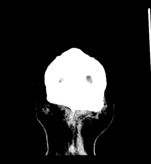 Chronic bilateral subdural hygroma (Radiopaedia 85801-101623 B 10).jpg