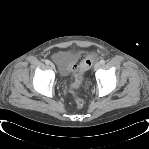 Chronic diverticulitis complicated by hepatic abscess and portal vein thrombosis (Radiopaedia 30301-30938 A 83).jpg