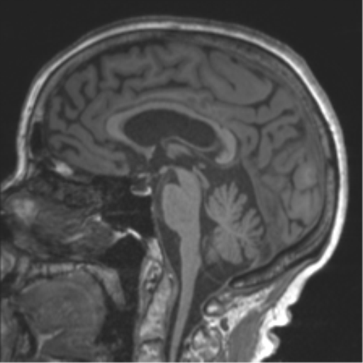 Chronic hypertensive encephalopathy (Radiopaedia 39993-42482 Sagittal T1 47).png
