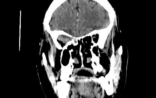 Chronic invasive fungal sinusitis (Radiopaedia 91563-109286 D 54).jpg
