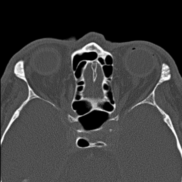 Chronic maxillary sinusitis (Radiopaedia 27879-28116 Axial bone window 38).jpg
