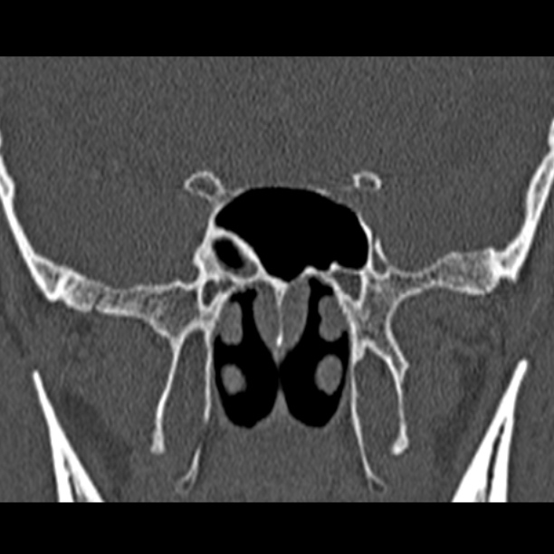 Chronic maxillary sinusitis (Radiopaedia 27879-28116 Coronal bone window 43).jpg