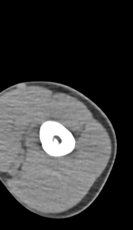 Chronic osteomyelitis of the distal humerus (Radiopaedia 78351-90971 Axial non-contrast 38).jpg