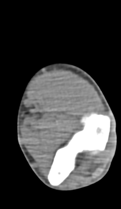 Chronic osteomyelitis of the distal humerus (Radiopaedia 78351-90971 Axial non-contrast 90).jpg