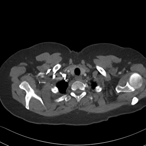 File:Chronic pulmonary embolus (Radiopaedia 39129-41341 Axial C+ CTPA 11).png