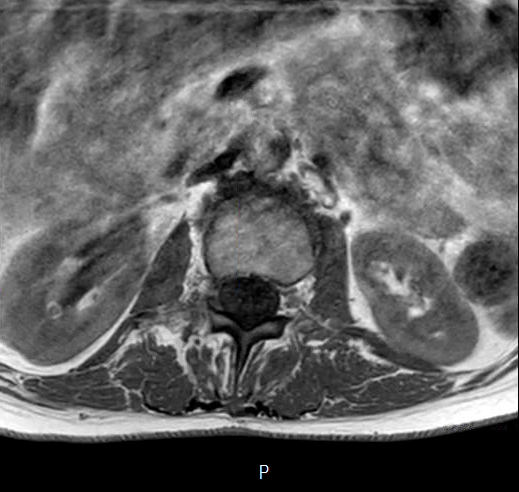 File:Chronic spinal hematoma with cauda equina syndrome (Radiopaedia 75745-87090 Axial T1 5).png