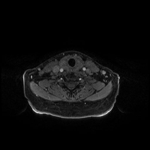 Chronic submandibular sialadenitis (Radiopaedia 61852-69885 Axial T1 C+ fat sat 10).jpg