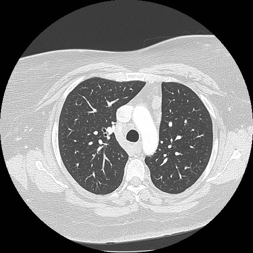 File:Cicatrisation collapse (Radiopaedia 17405-17089 lung window 38).jpg