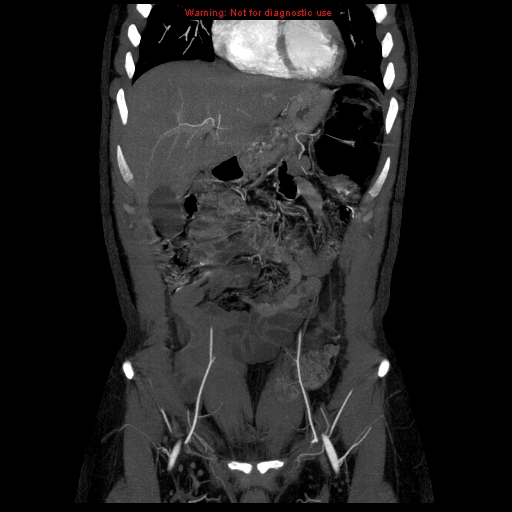 File:Circumaortic left renal vein (Radiopaedia 9069-9792 B 2).jpg