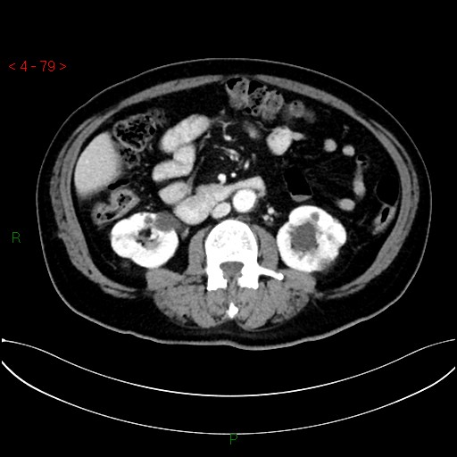 File:Circumaortic left renal vein and doubled left renal arteries (Radiopaedia 52268-58158 B 39).jpg