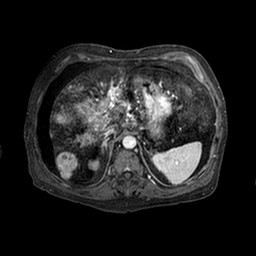 File:Cirrhosis and hepatocellular carcinoma in the setting of hemochromatosis (Radiopaedia 75394-86594 Axial T1 C+ fat sat 221).jpg
