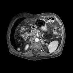 Cirrhosis and hepatocellular carcinoma in the setting of hemochromatosis (Radiopaedia 75394-86594 Axial T1 C+ fat sat 302).jpg