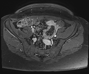 File:Class II Mullerian duct anomaly- unicornuate uterus with rudimentary horn and non-communicating cavity (Radiopaedia 39441-41755 Axial T1 fat sat 21).jpg
