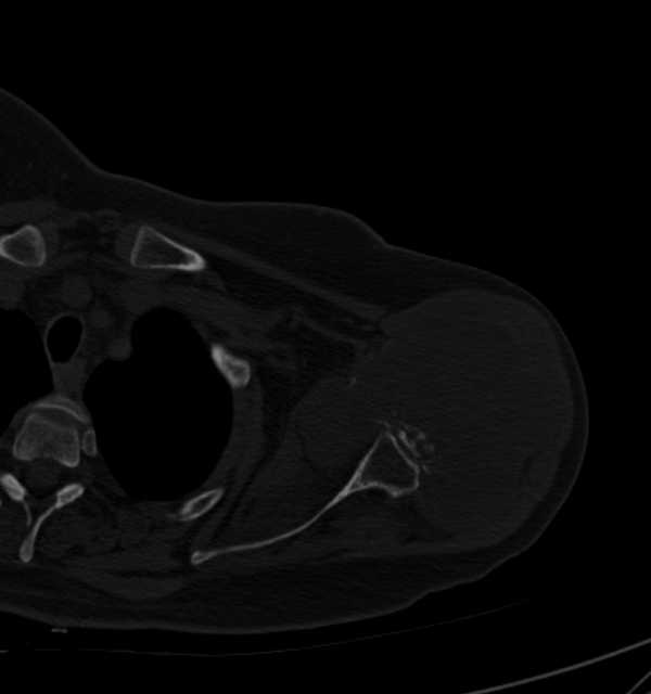 Clear cell chondrosarcoma - humerus (Radiopaedia 63104-71612 Axial bone window 36).jpg