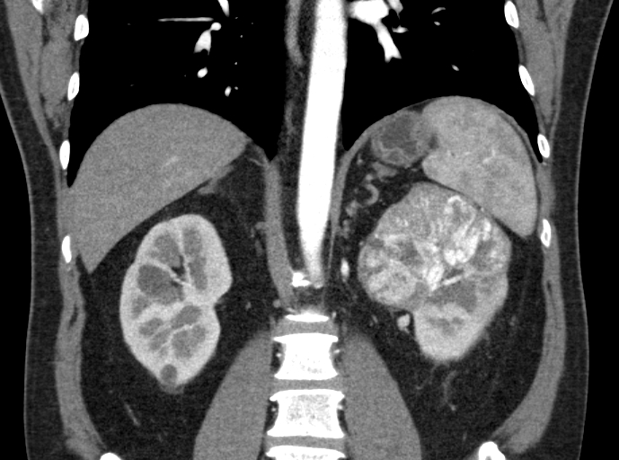 File:Clear cell renal cell carcinoma (Radiopaedia 61449-69393 C 27).jpg