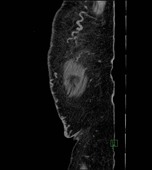 Closed-loop small bowel obstruction-internal hernia (Radiopaedia 78439-91096 C 13).jpg