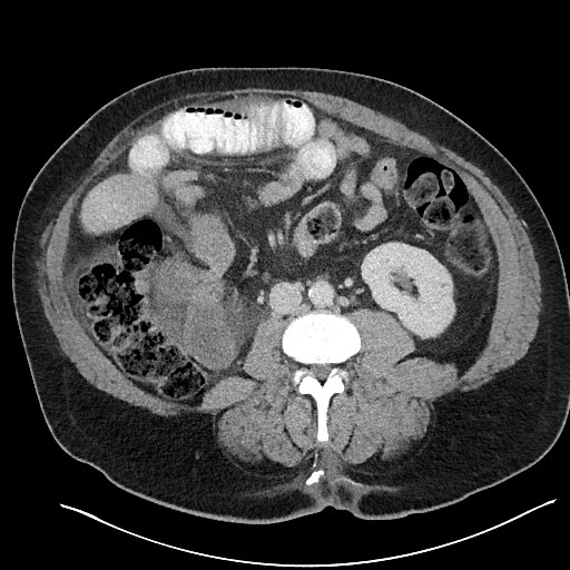 File:Closed loop obstruction - internal hernia into nephrectomy bed (Radiopaedia 59867-67320 A 76).jpg