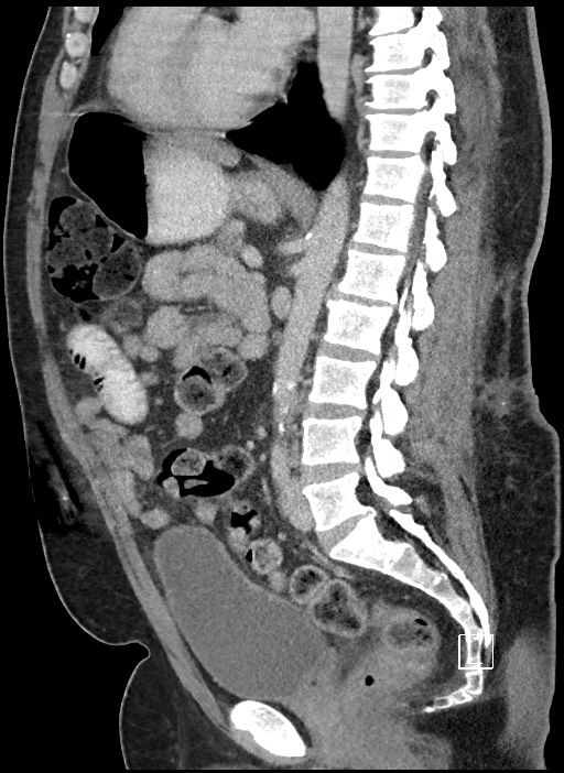 Closed loop obstruction - internal hernia into nephrectomy bed (Radiopaedia 59867-67320 C 41).jpg