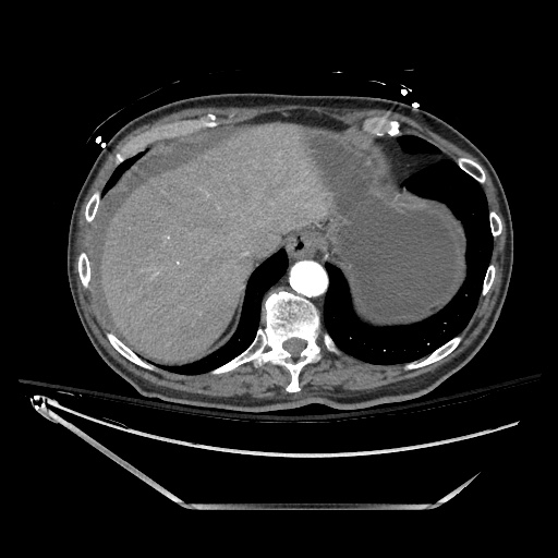File:Closed loop obstruction due to adhesive band, resulting in small bowel ischemia and resection (Radiopaedia 83835-99023 B 27).jpg
