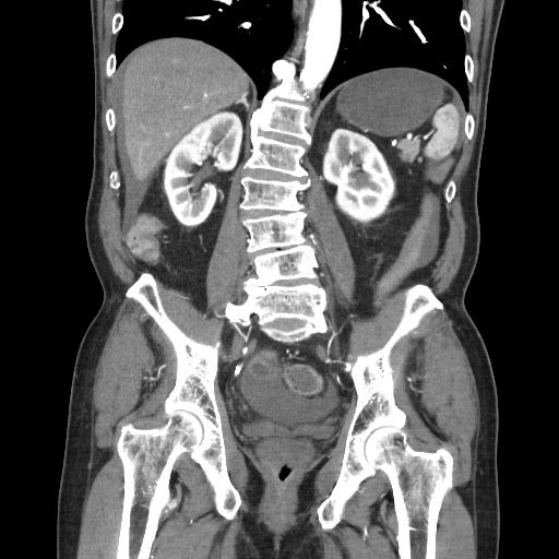 Closed loop obstruction due to adhesive band, resulting in small bowel ischemia and resection (Radiopaedia 83835-99023 C 82).jpg