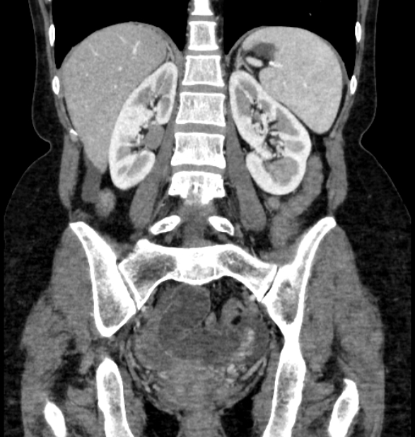 Closed loop small bowel obstruction (Radiopaedia 71211-81508 B 85).jpg