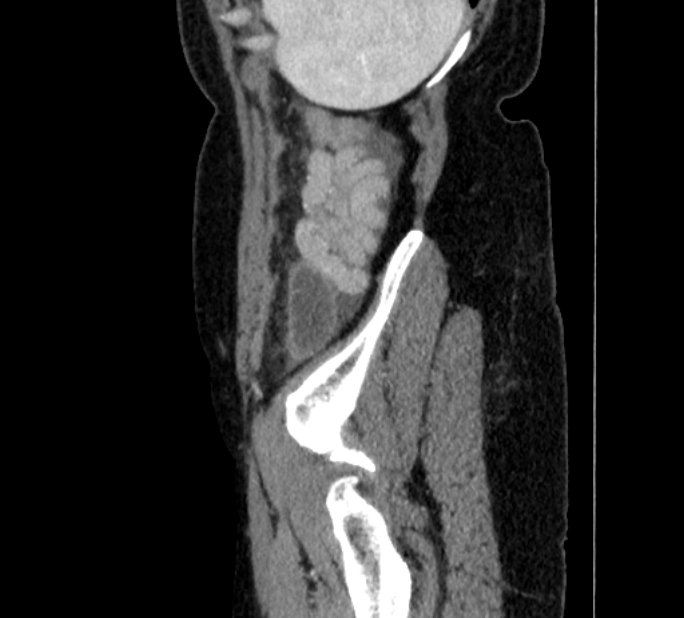 Closed loop small bowel obstruction (Radiopaedia 71211-81508 C 152).jpg