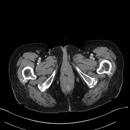 Closed loop small bowel obstruction - adhesions (Radiopaedia 59269-66611 A 145).jpg