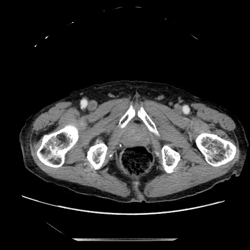 Closed loop small bowel obstruction - adhesive disease and hemorrhagic ischemia (Radiopaedia 86831-102990 A 181).jpg