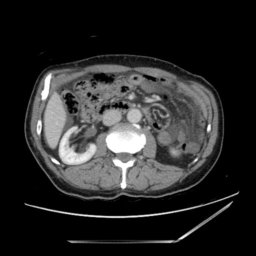 Closed loop small bowel obstruction - omental adhesion causing "internal hernia" (Radiopaedia 85129-100682 A 72).jpg