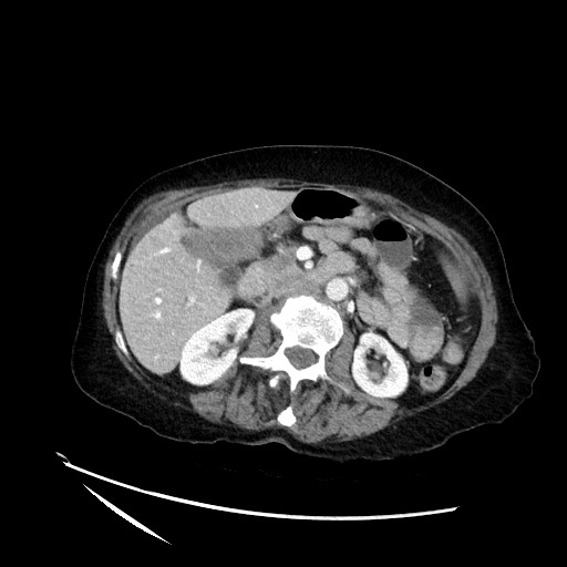 File:Closed loop small bowel obstruction due to adhesive band, with intramural hemorrhage and ischemia (Radiopaedia 83831-99017 Axial 43).jpg