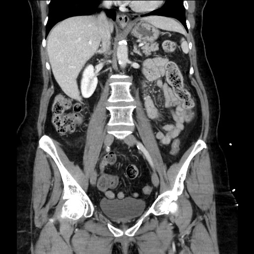 File:Closed loop small bowel obstruction due to adhesive bands - early and late images (Radiopaedia 83830-99014 B 67).jpg
