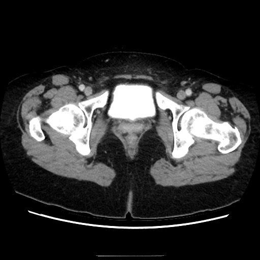 Closed loop small bowel obstruction due to adhesive bands - early and late images (Radiopaedia 83830-99015 A 165).jpg