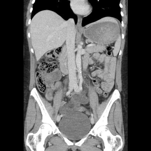 File:Closed loop small bowel obstruction due to trans-omental herniation (Radiopaedia 35593-37109 B 29).jpg